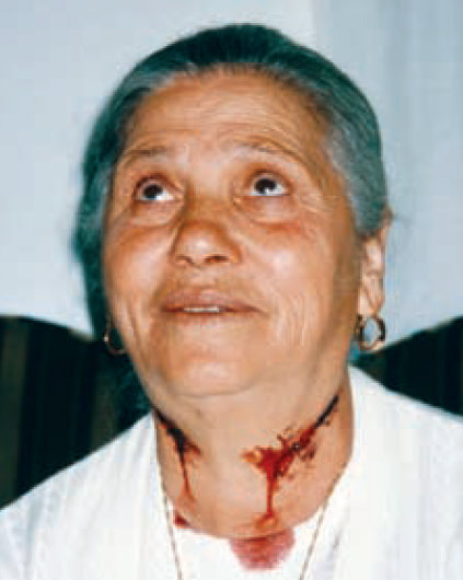 Photo of Nohad El Shamy with her neck wounds visible